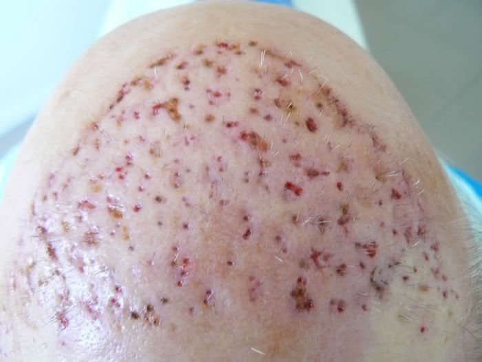 Hair plugs trypophobia phrase simply Hair plugs trypophobia can
